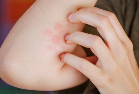 При повреждениях кожи